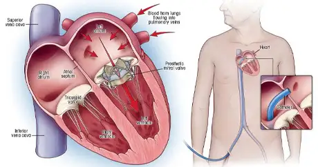 heart valve replacement Surgery in Delhi NCR